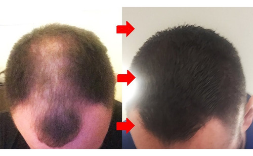 Dermaroller 0,5mm Derma Roller System 540 Agulhas Capilar