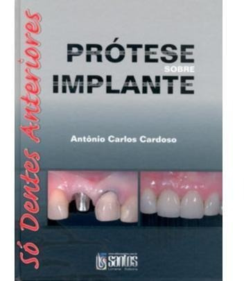 Prótese Sobre Implante - Só Dentes Anteriores