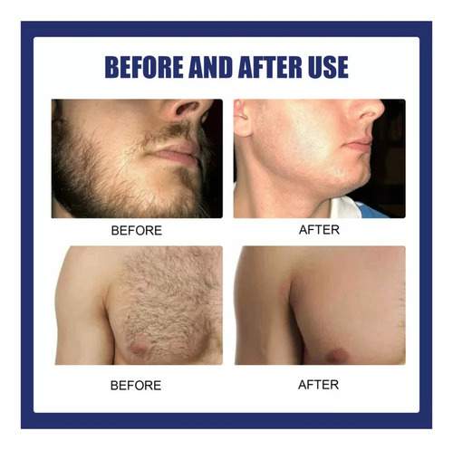 - 3×crema De Depilación Permanente-removedor De Barba Y