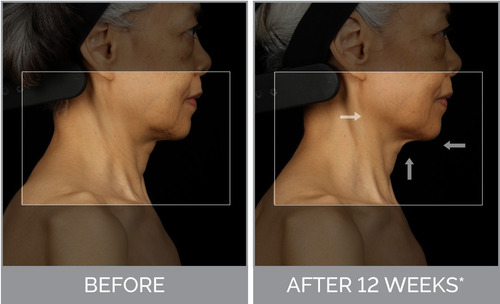 Clarisonic 30% Descuento Smartprofile Uplift 2 En 1 Antiedad