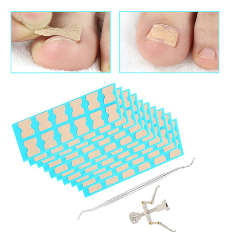 Parche De Corrección De Uñas Encarnadas Corrector De Uñas En
