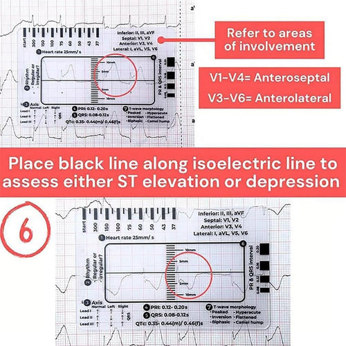 Regla Ecg De 7 Pasos De 2 Piezas, Regla De Ecg De 7 Pasos Pa