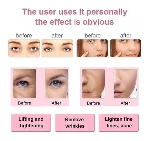 Máquina Radiofrecuencia Anti Envejecimiento Elevación Facial