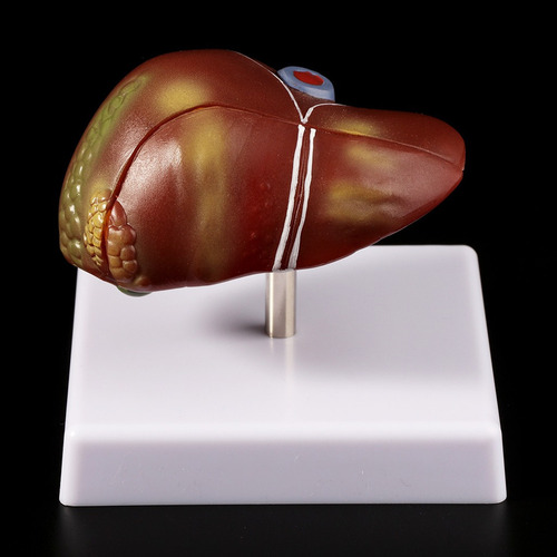 S Fígado Humano Patológico Anatômico Modelo Anatomia Escola