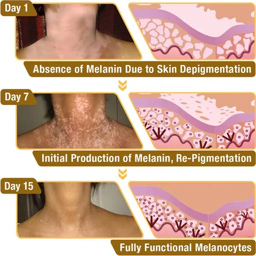 J Crema Para El Tratamiento Del Vitiligo De Veneno De Abeja