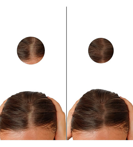 Minoxidil 1mg 100 Tabletas Minoxihead
