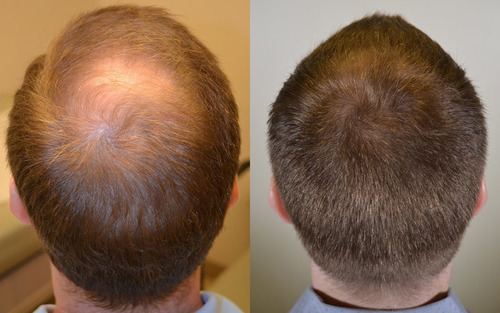 Profolan Estimulación Del Cabello No Caídas Mejor Color