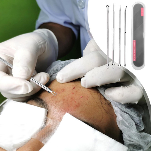 Extractor De Comedones Herramienta Extractora De Espinillas