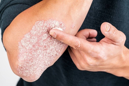 Psoriasis Y Dermatitis