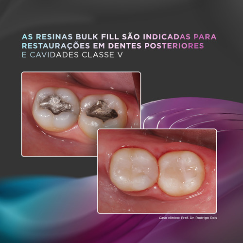 Resina Comp Odonto Foto Rest Opus Bulk Fill Flow Aps A1 Fgm