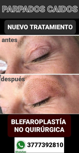 Imagen 3 de 4 de Parpados Caidos. Blefaroplastia No Quirurgica (plasma Laser)