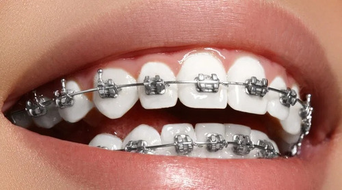 Ortodoncia Brackets 