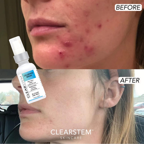 Suero Facial Clearstem Cellenrew Con Células Madre Y Ácido H