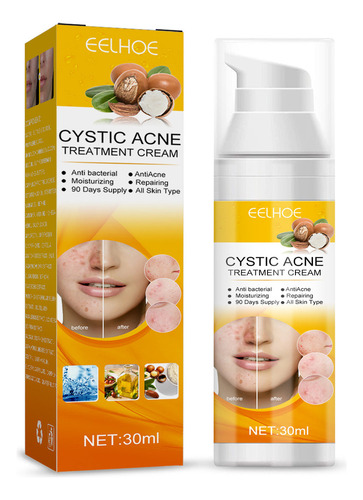 . Crema For Tratar El Acné: Combate El Acné Hormonal
