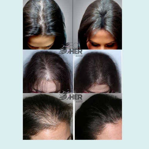 Tratamiento Minoxidil Para Crecimiento Cabello