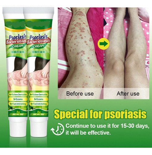 4×psoríase Creme Creme Para Remover Pi Moss