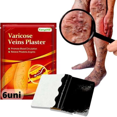 Emplasto para várices y dolor en las piernas