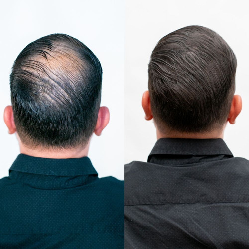 Fh Maquillaje Capilar Para Calvicie Y Dar Volumen Al Peinado