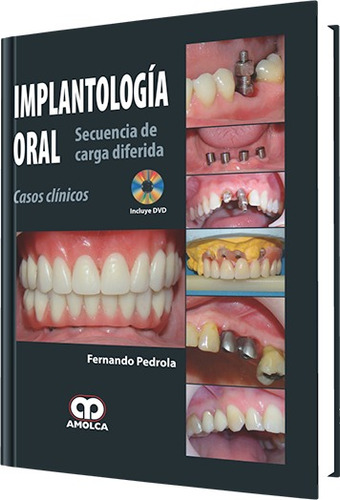 Implantología Oral Secuencia Carga Diferida Casos / Amolca