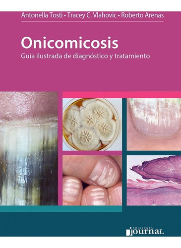 Onicomicosis Guia Ilustrada De Diagnostico Y Tratamiento