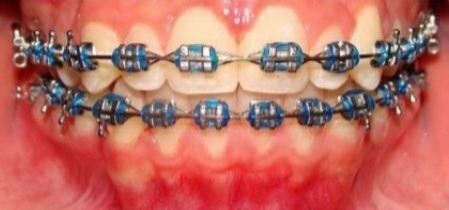 Ortodoncia Con Brackets Zafiro