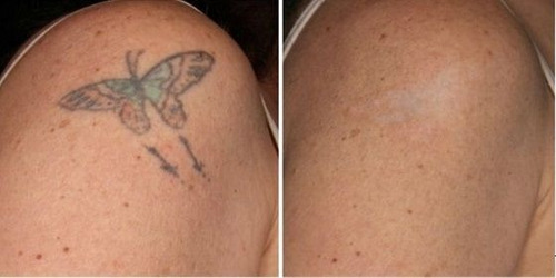 Eliminación De Tatuajes 