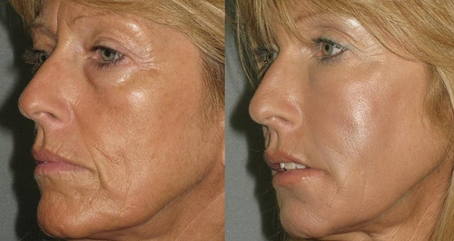 Skindulgence Rejuvenecimiento Facial Sin Cirugía 30 Min Tipo De Piel Todo Tipo De Piel