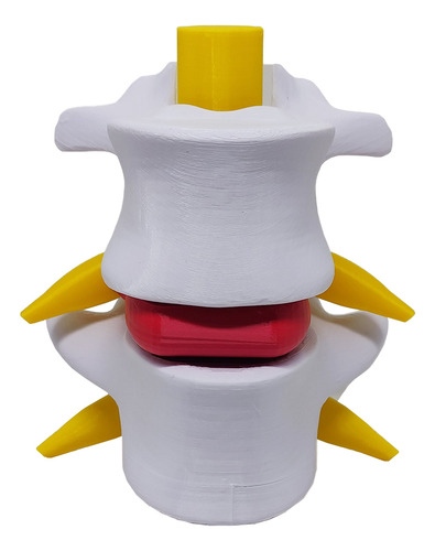 Modelo Anatômico Hérnia Disco Coluna Vertebral 3d
