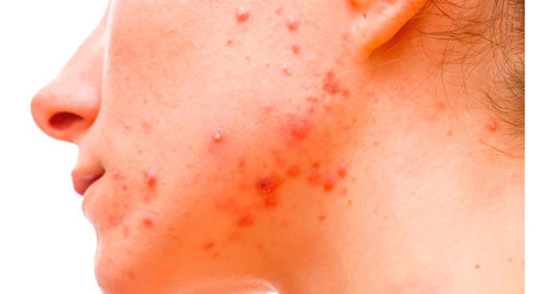 Imagen 4 de 4 de Acnepril Pildoras Para Eliminar El Cutis Curar El Acne