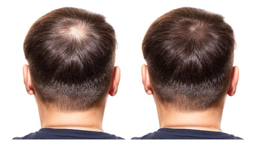 Profolan Estimulación Del Cabello No Caídas Mejor Color