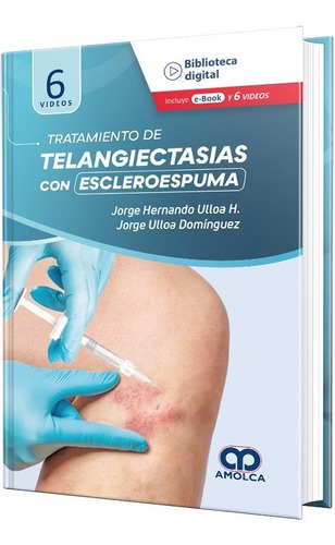 Tratamiento De Telangiactasias Con Escleroespuma.