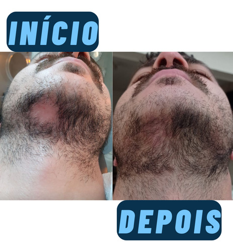 Kit Tônico Poderoso - Calvície - Alopecia - Queda/cabelo