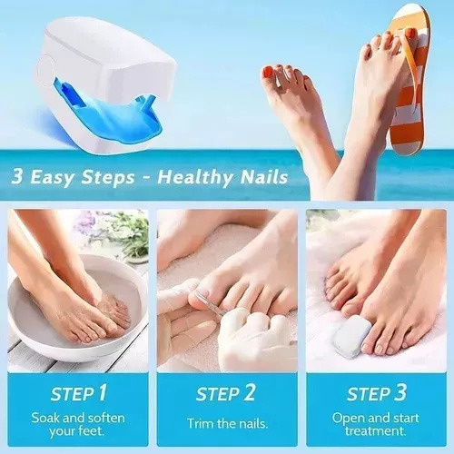 Laser Para Quitar Hongos De Las Uñas. Onicomicosis Láser