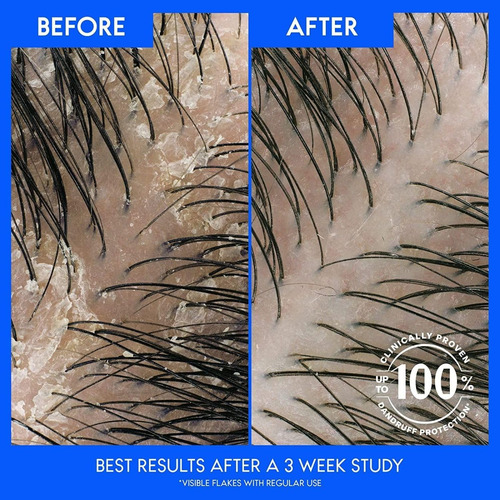ChampĂș Anticaspa Head & Shoulders, Tratamento Anticaspa Y 2