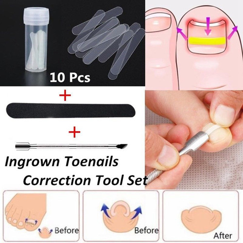 Parches De Corrección De Uñas Pies Encarnadas. Herramienta