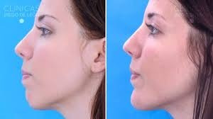 Imagen 5 de 6 de Remodelacion Facial Con Acido Hialuronico. 098 173 504