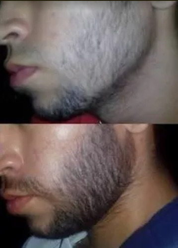 Tratamiento Del Vello Facial Crecer Barba Cabello Bigote 