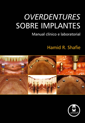 Overdentures Sobre Implantes: Manual Clínico e Laboratorial, de Shafie, Hamid R.. Artmed Editora Ltda., capa mole em português, 2009