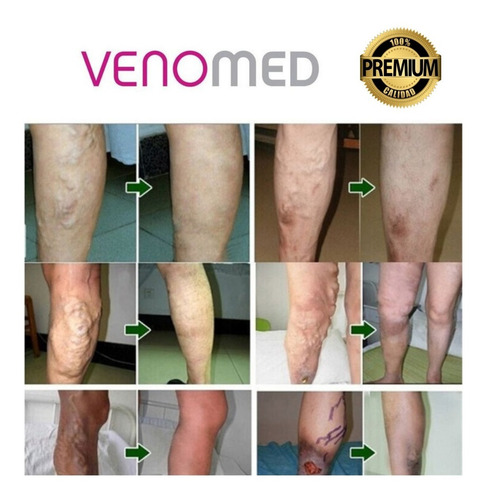 Medias Para Varices Compresion Agnovedades
