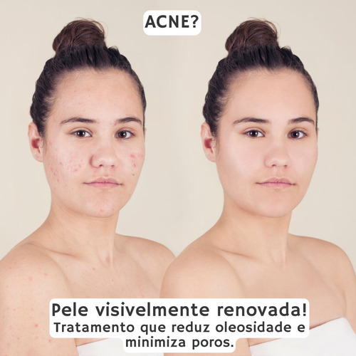 Máscara Removedora De Cravos E Espinhas Pele Acneica Limpeza Facial Todo Tipo De Pele Apolo