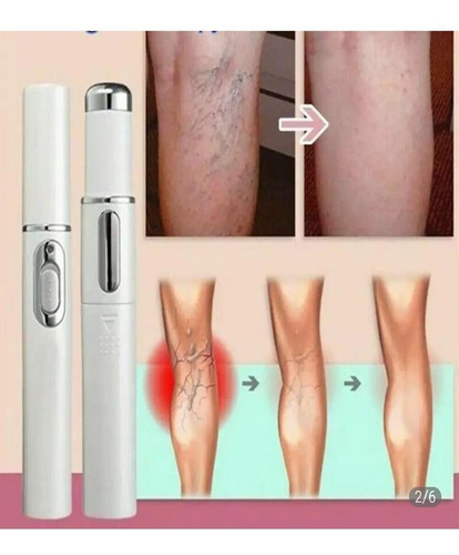 Caneta Tratamento Varizes/acne E Cicatrizes - Luz Led