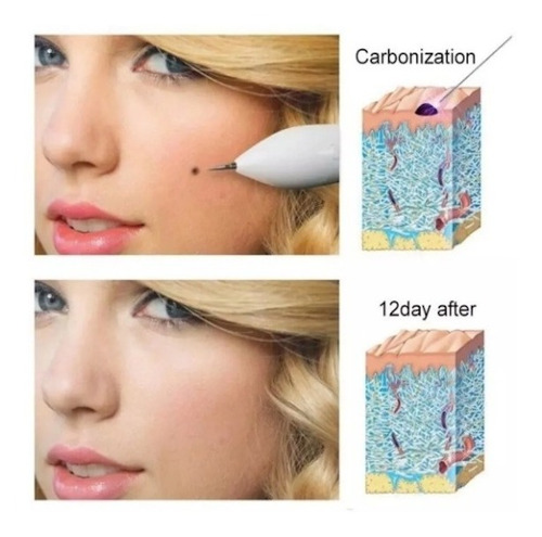 Imagen 5 de 8 de Lápiz Iones Elimina Pecas Lunares Verrugas Manchas Usb