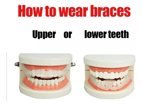 Protector Bucal Antimolar De 6 Piezas Para Rechinar Dientes