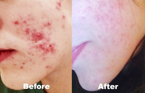 Imagen 9 de 10 de Sebum Clean Espuma De Limpieza 170ml Exel