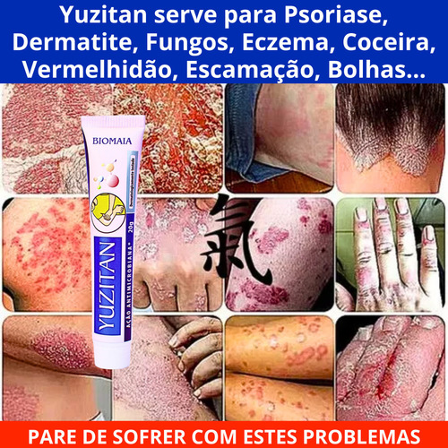 Dermatite Alergia Coceira Com Vermelhidão Braço Perna Mão