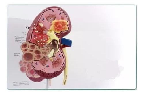 Modelo Anatômico P/ Estudo Rim Com Patologia
