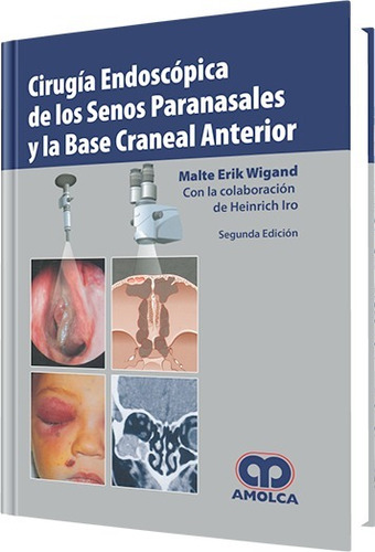 Cirugia Endoscopica De Senos Paranasales Y La Base Craneal