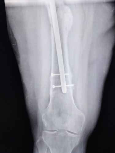 Membresía Fracturas 101