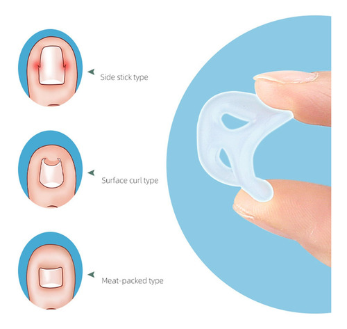 10 Uds. De Silicona Para Corregir Las Uñas Encarnadas,