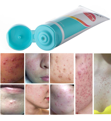 Q 35g Face Removal Cream Pimple Spots Scar Stretch Skin Care